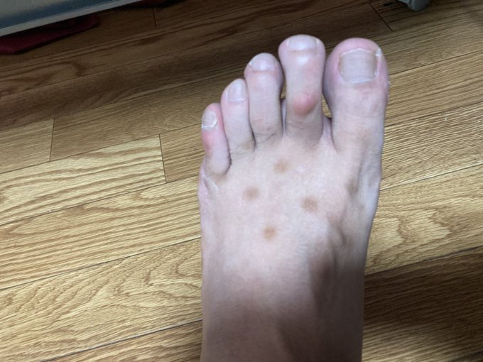 14日時点の、左足